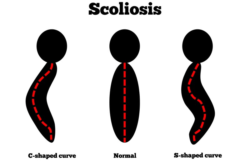 State College, PA scoliosis treatment